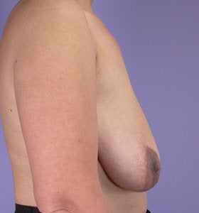 Breast Reduction