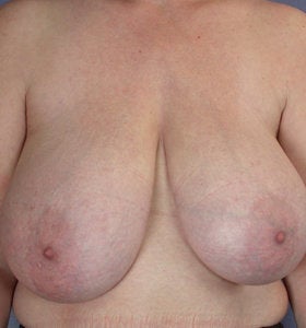 Breast Reduction