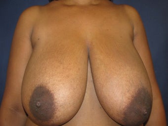 Breast Reduction