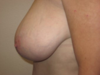 Breast Reduction