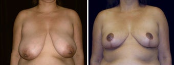 37 year old female, breast reduction