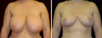 23 year old female, breast reduction