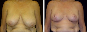58 year old female, breast reduction