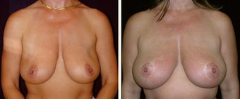 42 year old female, breast reduction