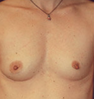 Breast implant removal