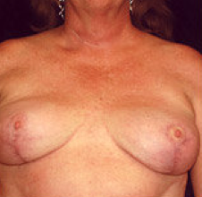 Breast implant removal and breast lift.