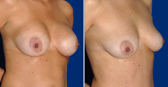 Breast Implant Removal