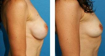 Breast Implant Removal with Internal Lift