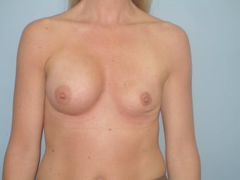 Complex Revisionary Breast Surgery-implant exhange after deflation