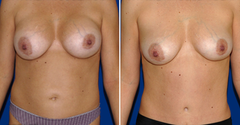 Breast Implant Removal