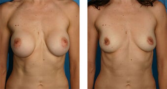 Breast Implant Removal with Internal Lift