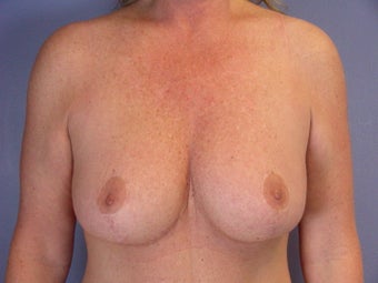 Breast Lift