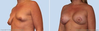 breast lift