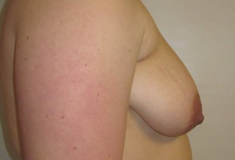 Mastopexy/ Breast Augmentation 