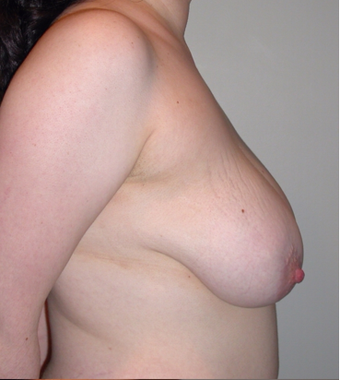 Vertical Breast Lift