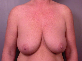 Breast Lift