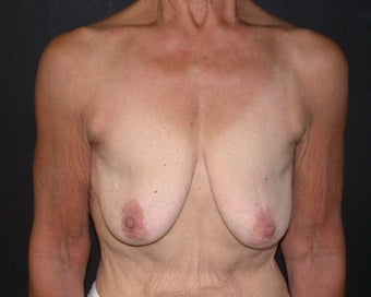 breast lift