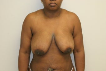  breast lift