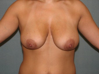 Breast lift