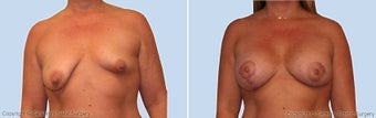 breast lift