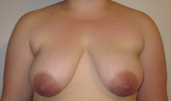 Mastopexy/ Breast Augmentation 