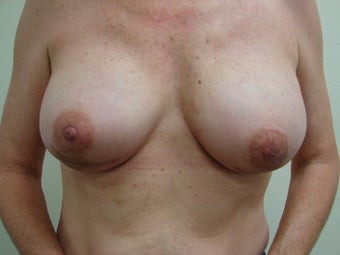 Breast Reconstruction Immediate 