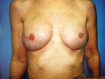 Breast Reconstruction
