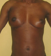 Brest Reconstruction With Natural Fat
