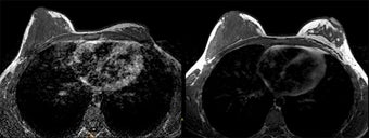 Breast Reconstruction