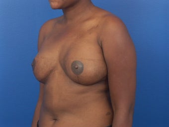 Breast Reconstruction following mastectomy