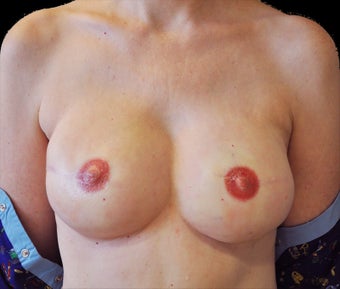 Breast reconstruction with silicone implants