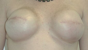Breast Reconstruction