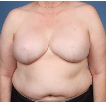 Breast Reconstruction