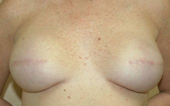 Breast Reconstruction