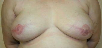 Breast Reconstruction