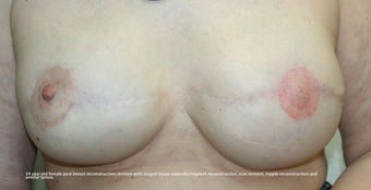 Revision of Reconstructed Breast