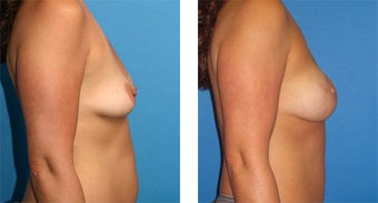 Breast Reconstruction: One-Stage Breast Reconstruction