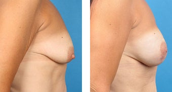 Breast Reconstruction: One-Stage Breast Reconstruction