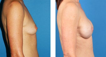 Breast Reconstruction: One-Stage Breast Reconstruction