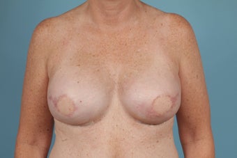 Latissimus Dorsi Breast Reconstruction