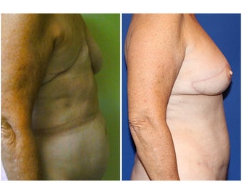 DIEP - Breast Reconstruction
