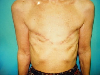 Breast Reconstruction