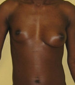 Brest Reconstruction With Natural Fat