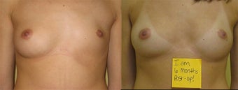 Breast Reconstruction