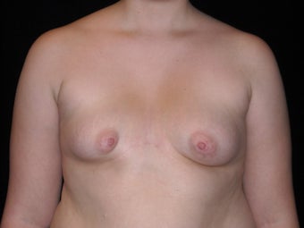 Breast reconstruction
