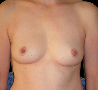 Breast reconstruction with silicone implants