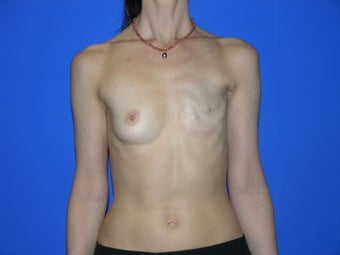 Breast Reconstruction