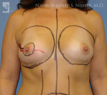 Breast Reconstruction
