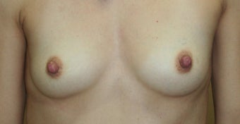 Breast Reconstruction