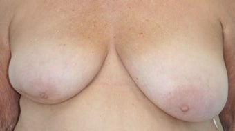 Breast Reconstruction